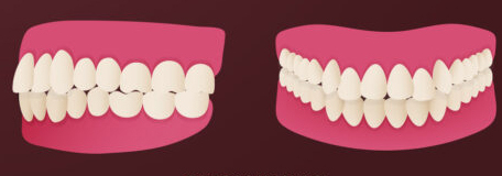 انواع مال اکلوژن